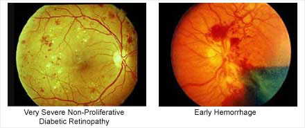 Severe non-proliferative diabetic retinopathy with early hemorrhage – Soroudi Advanced LASIK & Eye Centers Los Angeles