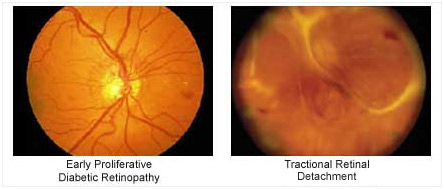 Early proliferative diabetic retinopathy with tractional detachment – Soroudi Advanced LASIK & Eye Centers Los Angeles