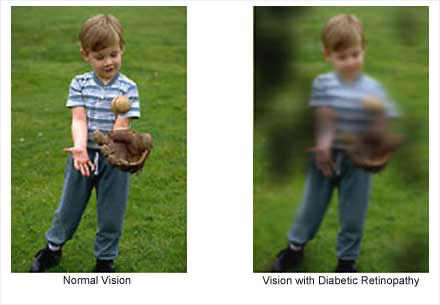 Child’s vision comparison: normal eyesight vs blurred vision from proliferative diabetic retinopathy – Soroudi Advanced LASIK & Eye Centers Los Angeles