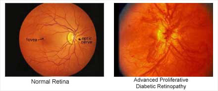 Normal retina compared with advanced proliferative diabetic retinopathy – Soroudi Advanced LASIK & Eye Centers Los Angeles
