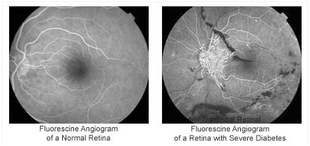 Fluorescein angiogram comparing normal retina vs diabetic retina – Soroudi Advanced LASIK & Eye Centers Los Angeles