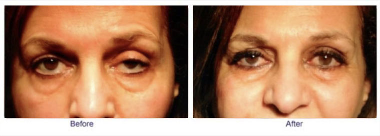 Ptosis surgery available in Los Angeles, Glendale, and Newport Beach – Soroudi Advanced LASIK & Eye Centers Los Angeles