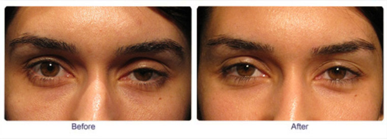 Patient undergoing droopy eyelid repair surgery – Soroudi Advanced LASIK & Eye Centers Los Angeles