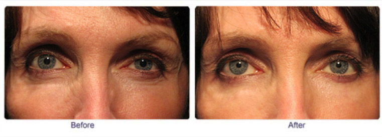 Droopy eyelid repair surgery result – Soroudi Advanced LASIK & Eye Centers Los Angeles