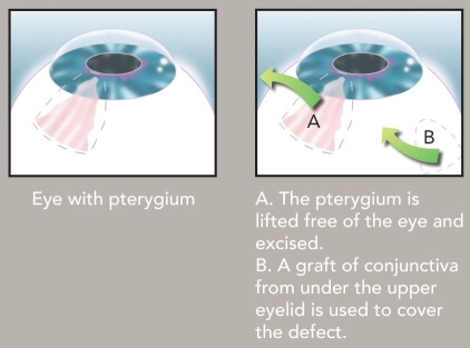 Eye lens with pterygium before and after removal – Soroudi Advanced LASIK & Eye Centers Los Angeles