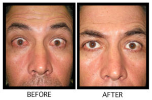 Before and after images showing eye redness treated – Soroudi Advanced LASIK & Eye Centers Los Angeles