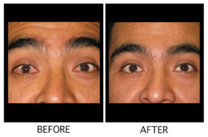 Comparison photos of treated red eyes before and after – Soroudi Advanced LASIK & Eye Centers Los Angeles