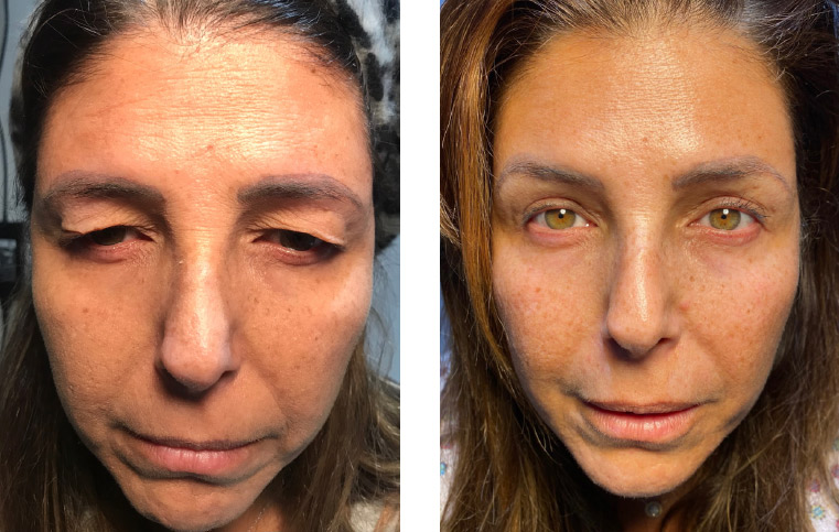 Upper Eyelid Surgery Before and After - Los Angeles, Beverly Hills, Newport Beach & Glendale