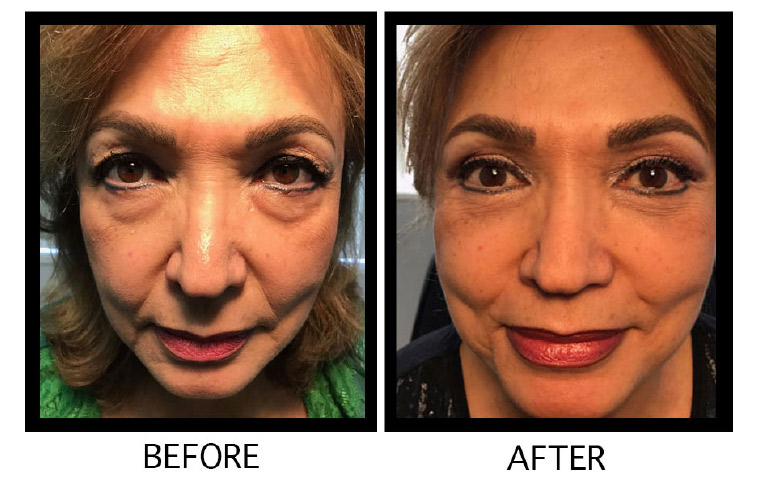 Eyelid cosmetic surgery (blepharoplasty) results in Los Angeles – Soroudi Advanced LASIK & Eye Centers