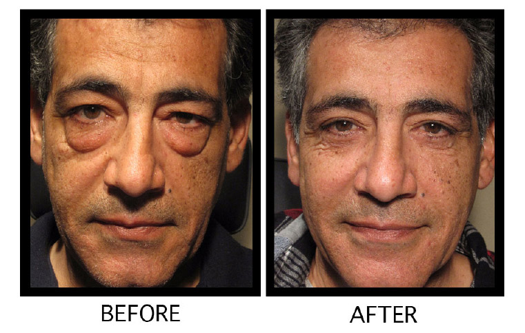 Upper and lower eyelid blepharoplasty results in Los Angeles – Soroudi Advanced LASIK & Eye Centers Los Angeles