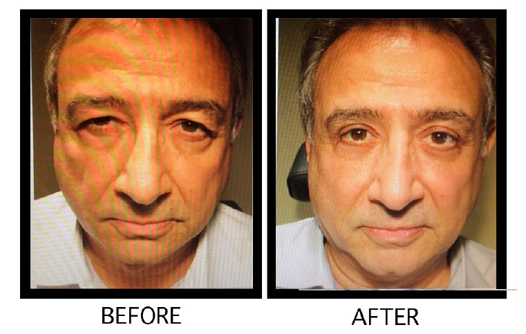 Blepharoplasty eyelid surgery procedure in Los Angeles – Soroudi Advanced LASIK & Eye Centers Los Angeles