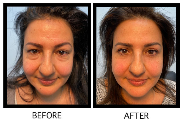 Cosmetic eye bag removal surgery in Los Angeles – Soroudi Advanced LASIK & Eye Centers Los Angeles