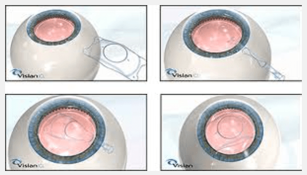 Close-up of intraocular lens (IOL) after implant surgery – Soroudi Advanced LASIK & Eye Centers Los Angeles