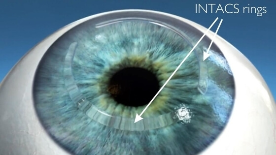 Intacs corneal implants placed on eye lens – Soroudi Advanced LASIK & Eye Centers Los Angeles