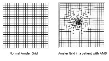 Amsler grid comparison: normal grid vs distorted grid with AMD – Soroudi Advanced LASIK & Eye Centers Los Angeles
