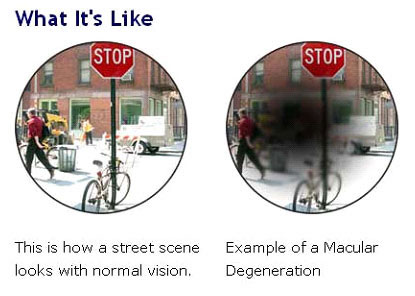 Comparison of normal street vision and macular degeneration vision – Soroudi Advanced LASIK & Eye Centers Los Angeles