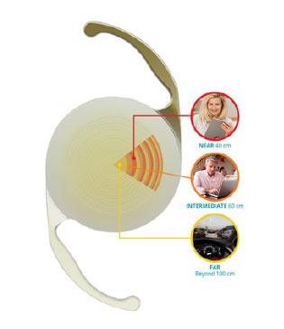 Multifocal intraocular lens (IOL) showing near, intermediate, and far vision correction – Soroudi Advanced LASIK & Eye Centers Los Angeles