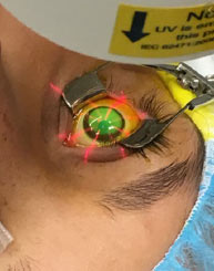 LASIK eye surgery treatment in progress – Soroudi Advanced LASIK & Eye Centers Los Angeles