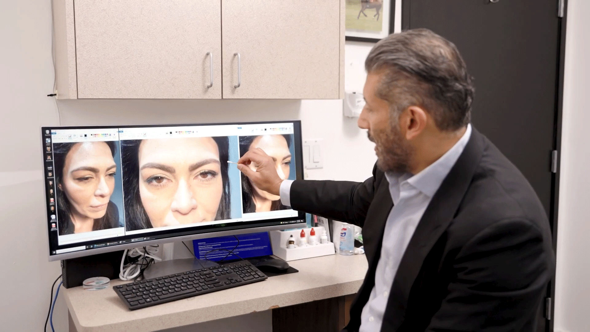 Upper eyelid ptosis repair combined with eyelid lift procedure – Soroudi Advanced LASIK & Eye Centers Los Angeles