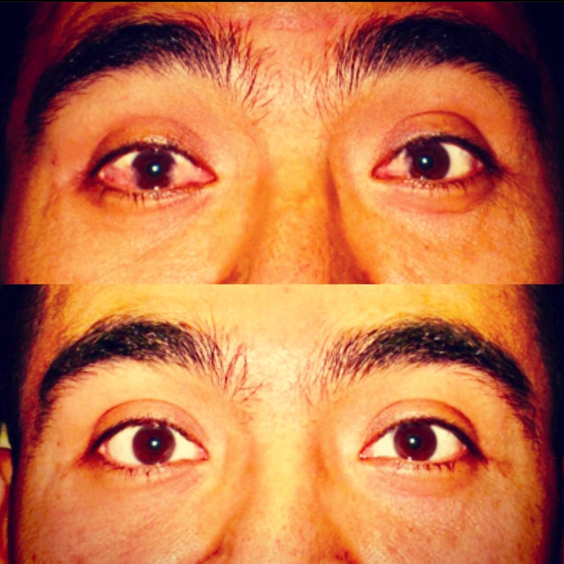 Eye Whitening Surgery (Conjunctivoplasty) Before & After - Male Patient by Dr. Soroudi - Los Angeles, Beverly Hills, Newport Beach & Glendale