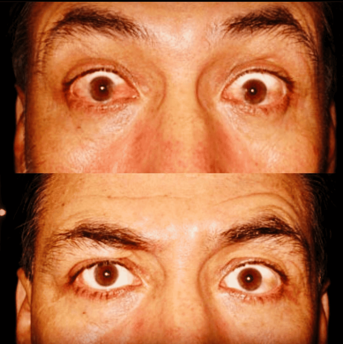 Male Patient Eye Whitening Surgery Results - Brightening & Cosmetic Correction by Dr. Soroudi - Los Angeles, Beverly Hills, Newport Beach & Glendale