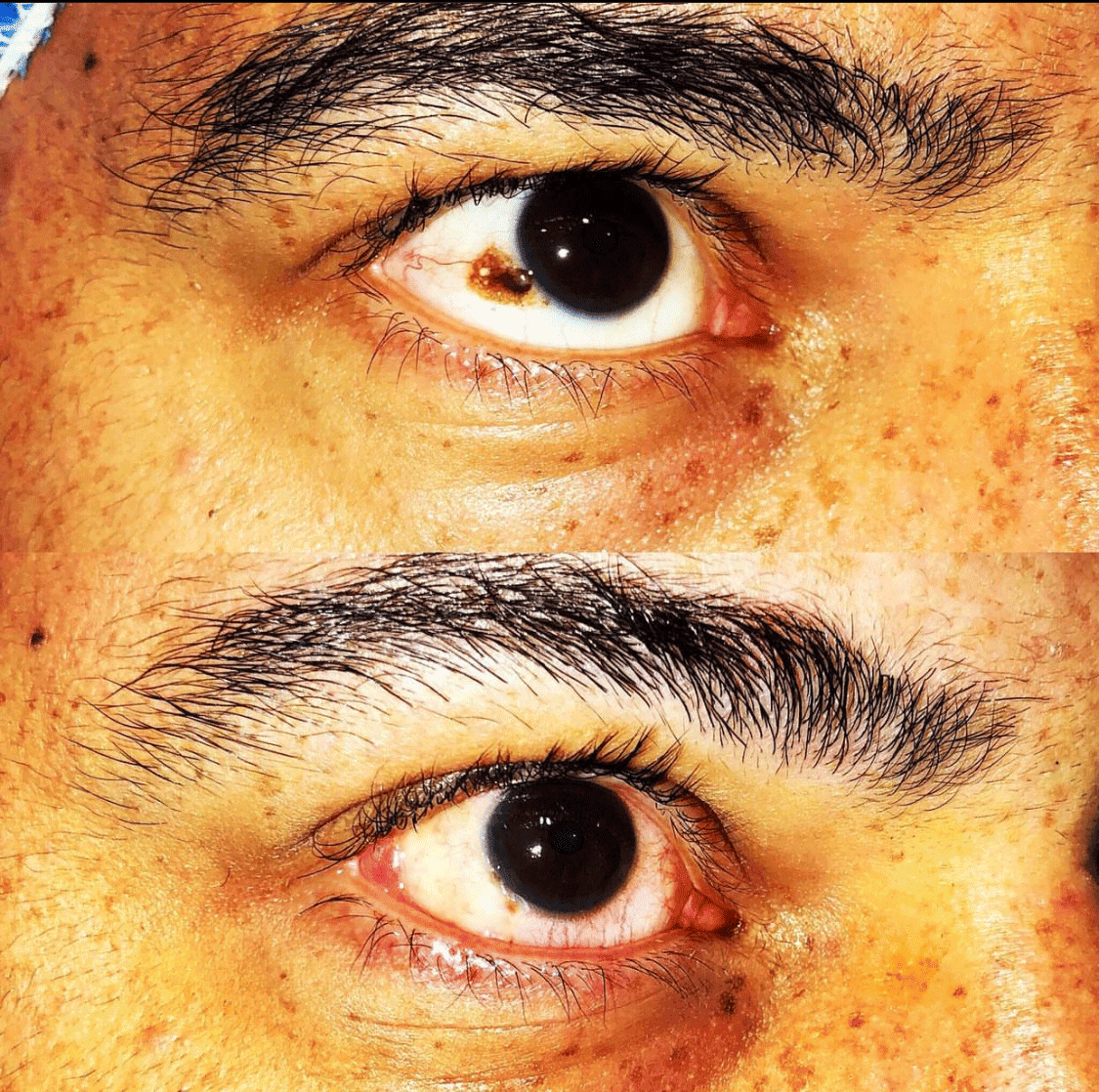 Cosmetic Eye Whitening (Redness Removal) Surgery Before & After - Male Patient with Dr. Soroudi - Los Angeles, Beverly Hills, Newport Beach & Glendale