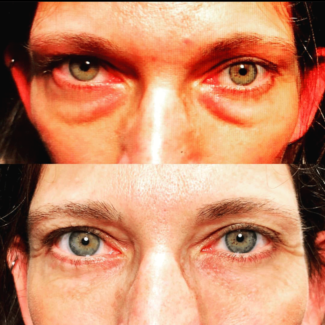 Blepharoplasty (Eyelid Surgery) Before & After by Dr. Soroudi - Los Angeles, Beverly Hills, Newport Beach & Glendale
