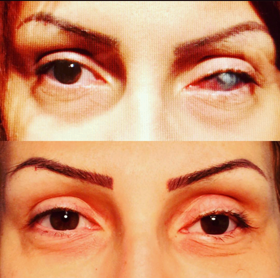Droopy Eyelid Lift (