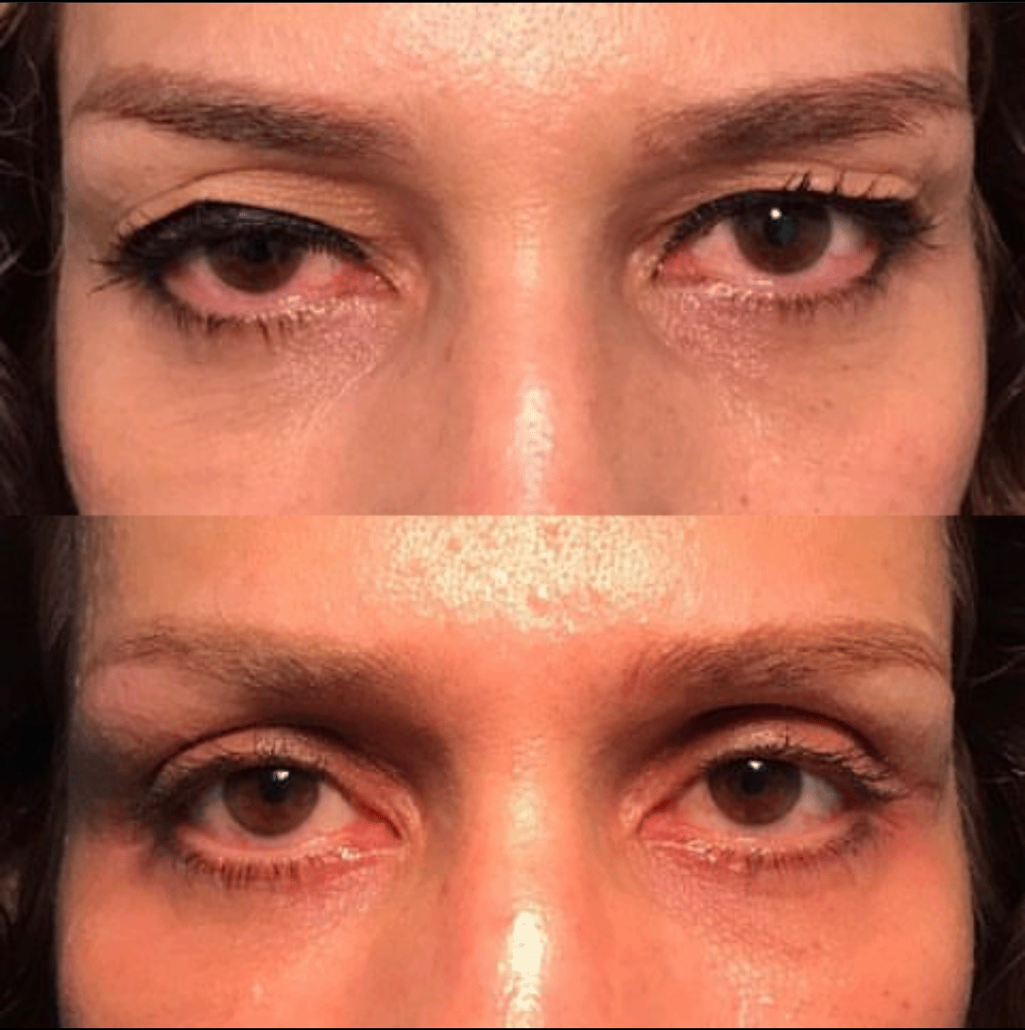 Droopy Eyelid Lift (