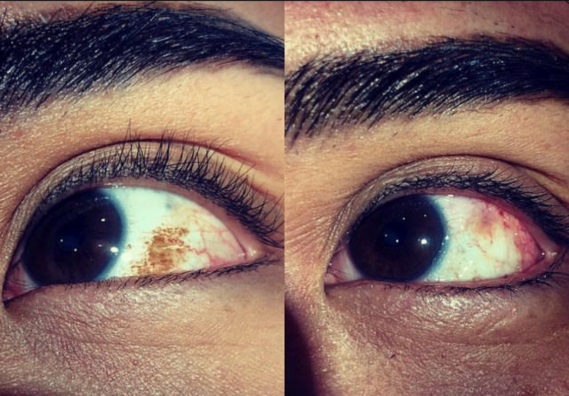 Eye Whitening Procedure (Cosmetic Eye Surgery) Transformation - Male Patient Treated by Dr. Soroudi - Los Angeles, Beverly Hills, Newport Beach & Glendale
