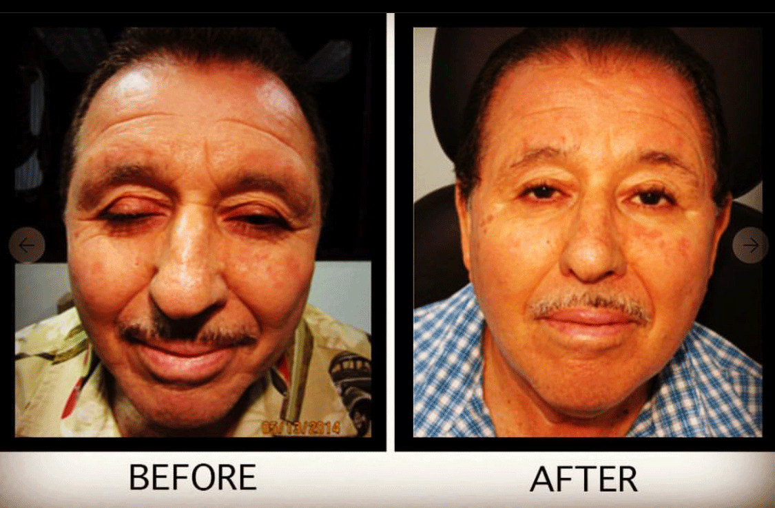 Droopy Eyelid Lift (