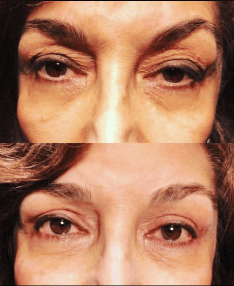Eyelid Surgery Before & After by Dr. Soroudi - Los Angeles, Beverly Hills, Newport Beach & Glendale