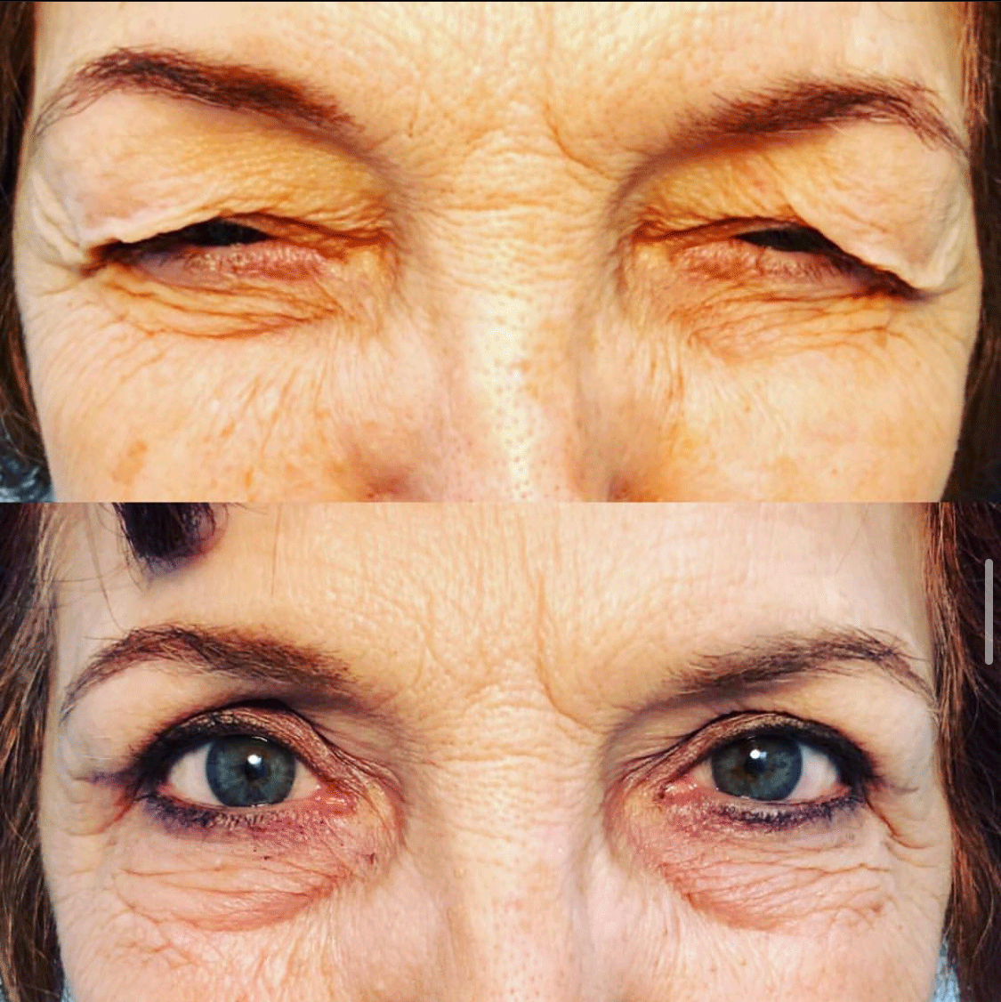 Droopy Eyelid Lift (
