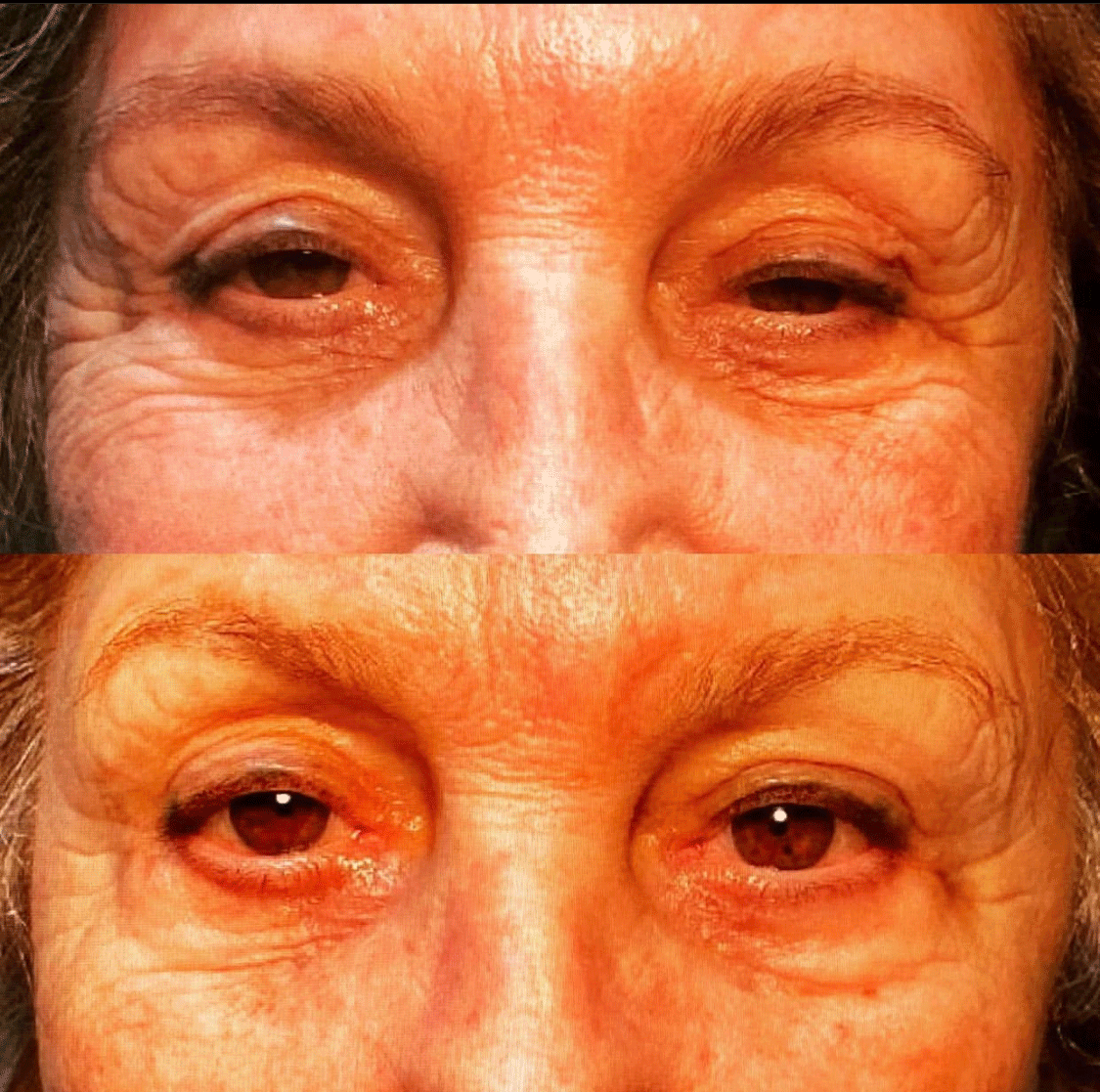 Ptosis Repair Eyelid Lift - Female Patient Results with Dr. Soroudi - Los Angeles, Beverly Hills, Newport Beach & Glendale
