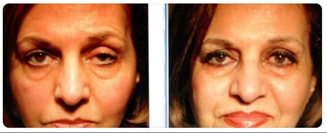 Corrective Eyelid Surgery for Droopy Lids (Ptosis Repair) - Female Patient Before & After by Dr. Soroudi - Los Angeles, Beverly Hills, Newport Beach & Glendale