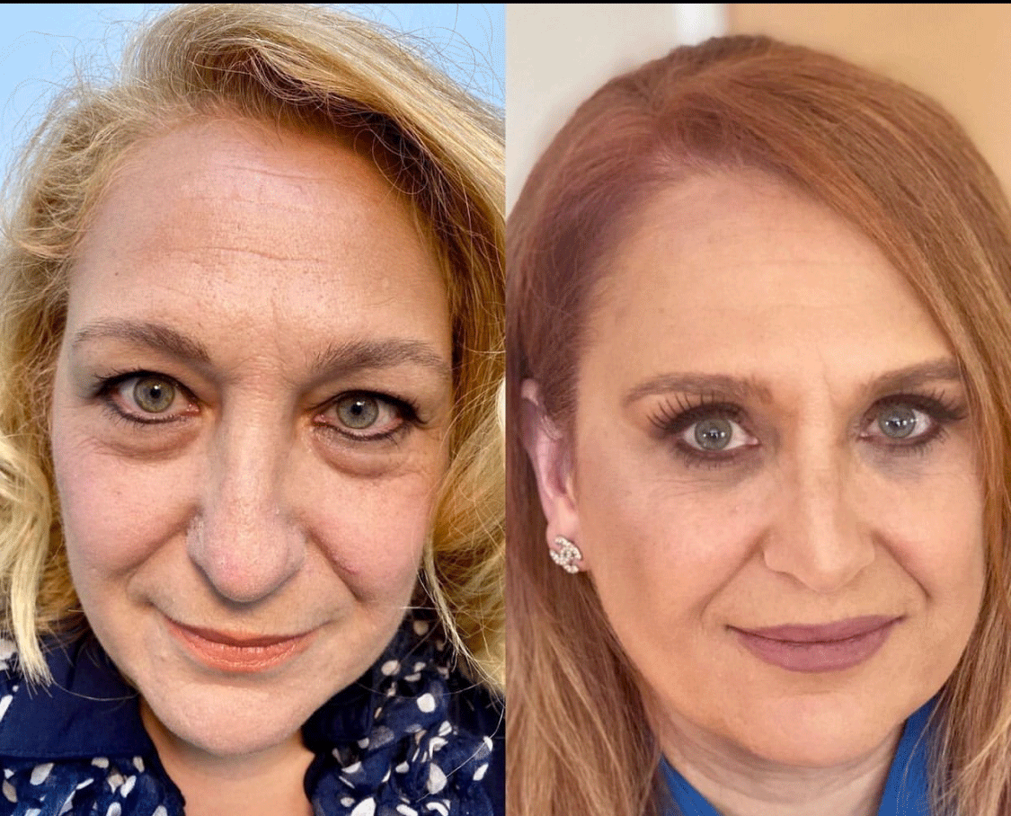Eyelid Surgery Before & After by Dr. Soroudi - Los Angeles, Beverly Hills, Newport Beach & Glendale