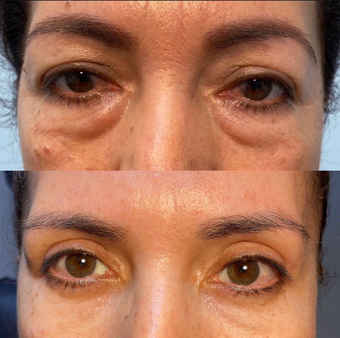 Eye Whitening Surgery Before & After - Female Patient Results by Dr. Soroudi - Los Angeles, Beverly Hills, Newport Beach & Glendale