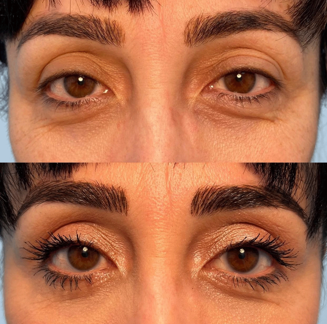Female Ptosis Repair (Droopy Eyelid Lift) Case Study - Before & After Results with Dr. Soroudi - Los Angeles, Beverly Hills, Newport Beach & Glendale