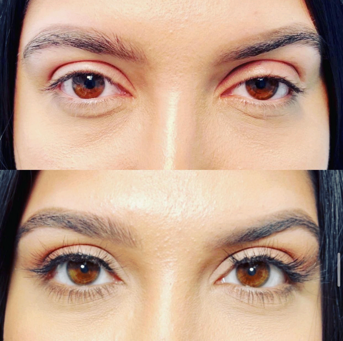 Droopy Eyelid Lift (Ptosis Repair) Surgery Before & After - Female Patient by Dr. Soroudi - Los Angeles, Beverly Hills, Newport Beach & Glendale
