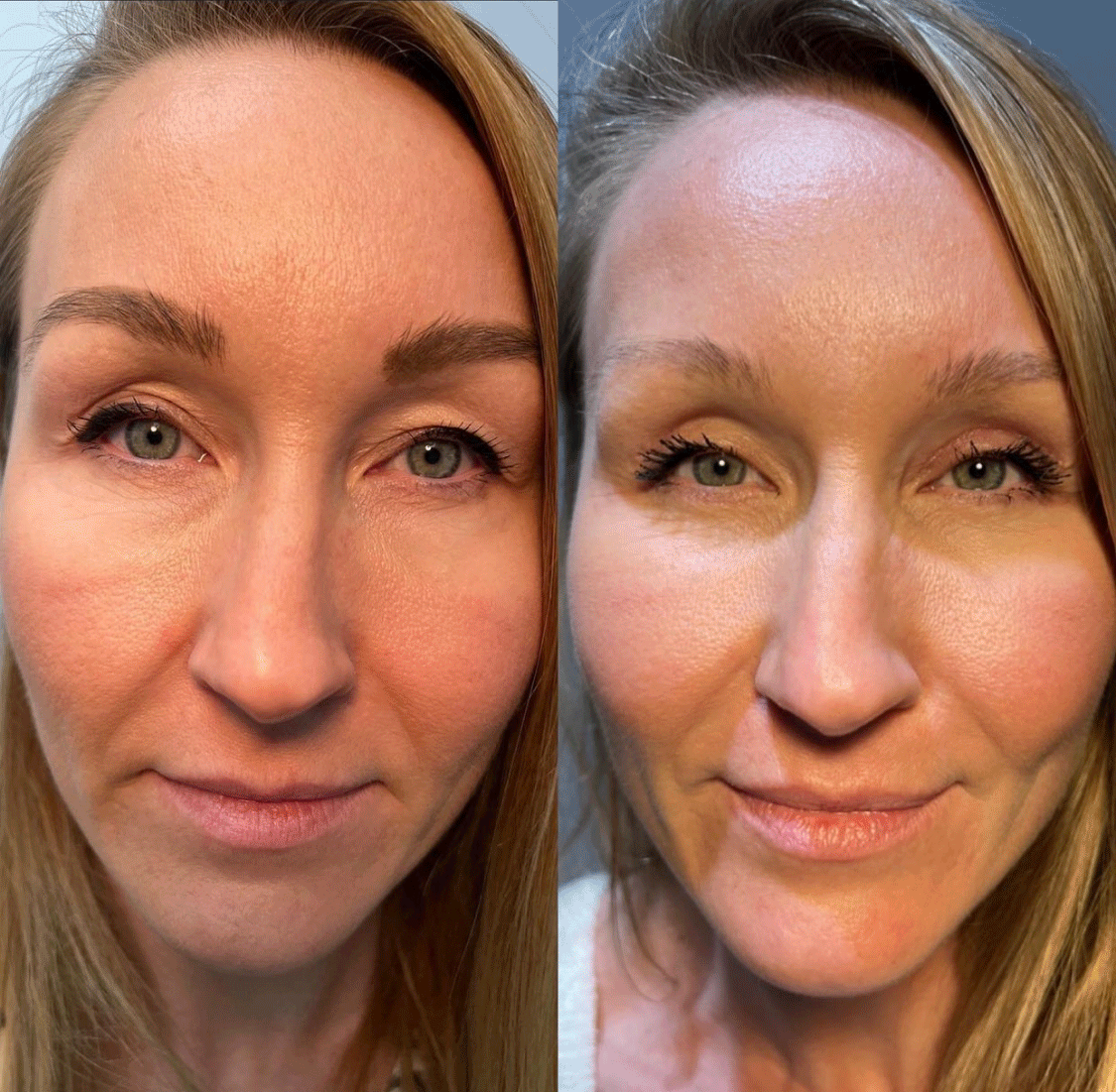 Blepharoplasty (Eyelid Surgery) Before & After - Female Patient by Dr. Soroudi - Los Angeles, Beverly Hills, Newport Beach & Glendale