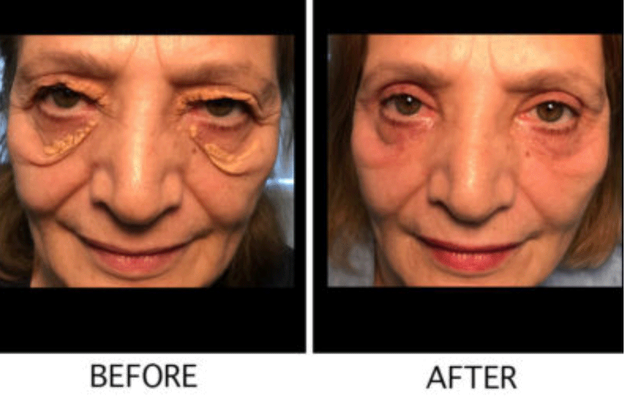 Xanthelasma Palpebrum Removal (Eyelid Surgery) Before & After - Female Patient by Dr. Soroudi - Los Angeles, Beverly Hills, Newport Beach & Glendale