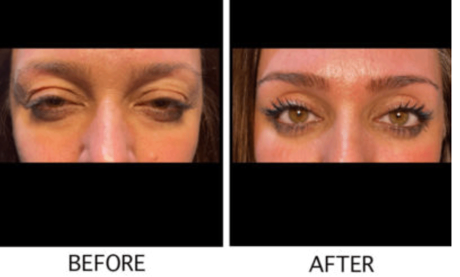 Droopy Eyelid Lift (Ptosis Repair) Results - Female Patient Treated by Dr. Soroudi - Los Angeles, Beverly Hills, Newport Beach & Glendale