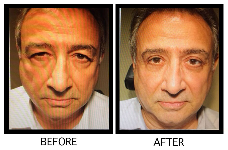 Ptosis Repair (Droopy Eyelid Surgery) Before & After - Male Patient by Dr. Soroudi - Los Angeles, Beverly Hills, Newport Beach & Glendale