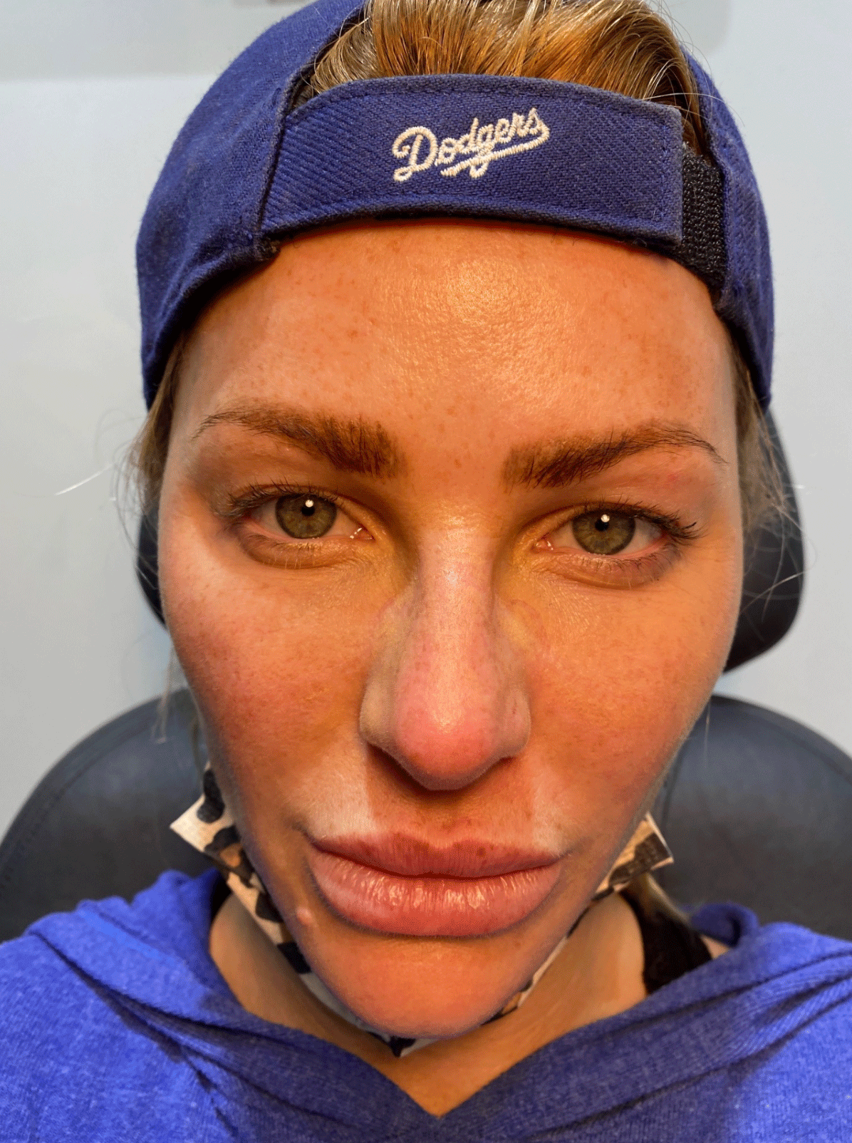Blepharoplasty (Eyelid Surgery) Before & After Gallery - Patient 63988924 - Image 1