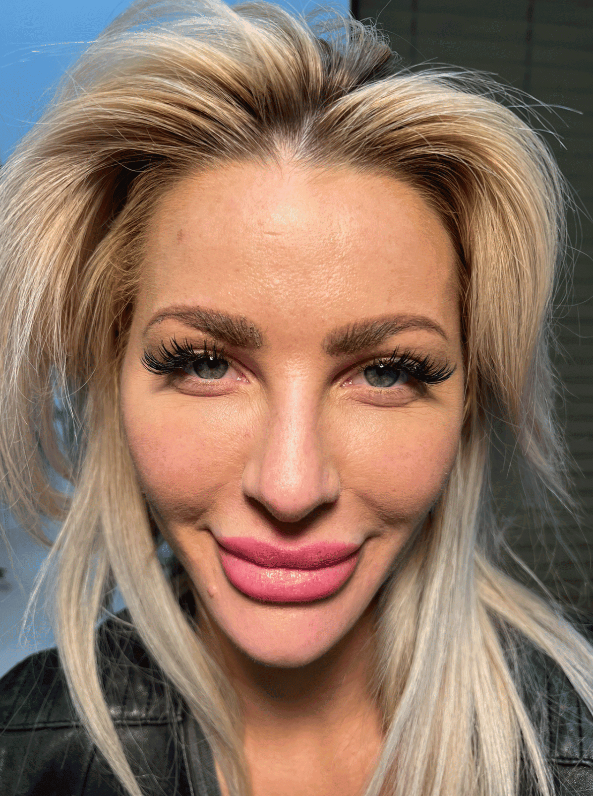 Blepharoplasty (Eyelid Surgery) After - Los Angeles, Beverly Hills, Newport Beach & Glendale