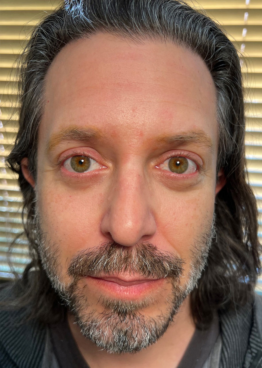 Blepharoplasty (Eyelid Surgery) After - Male Patient - Los Angeles, Beverly Hills, Newport Beach & Glendale