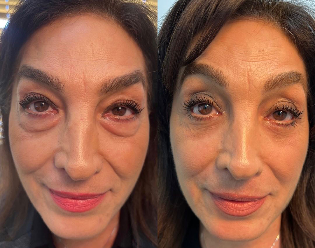 Blepharoplasty (Eyelid Surgery) After - Female Patient - Los Angeles, Beverly Hills, Newport Beach & Glendale