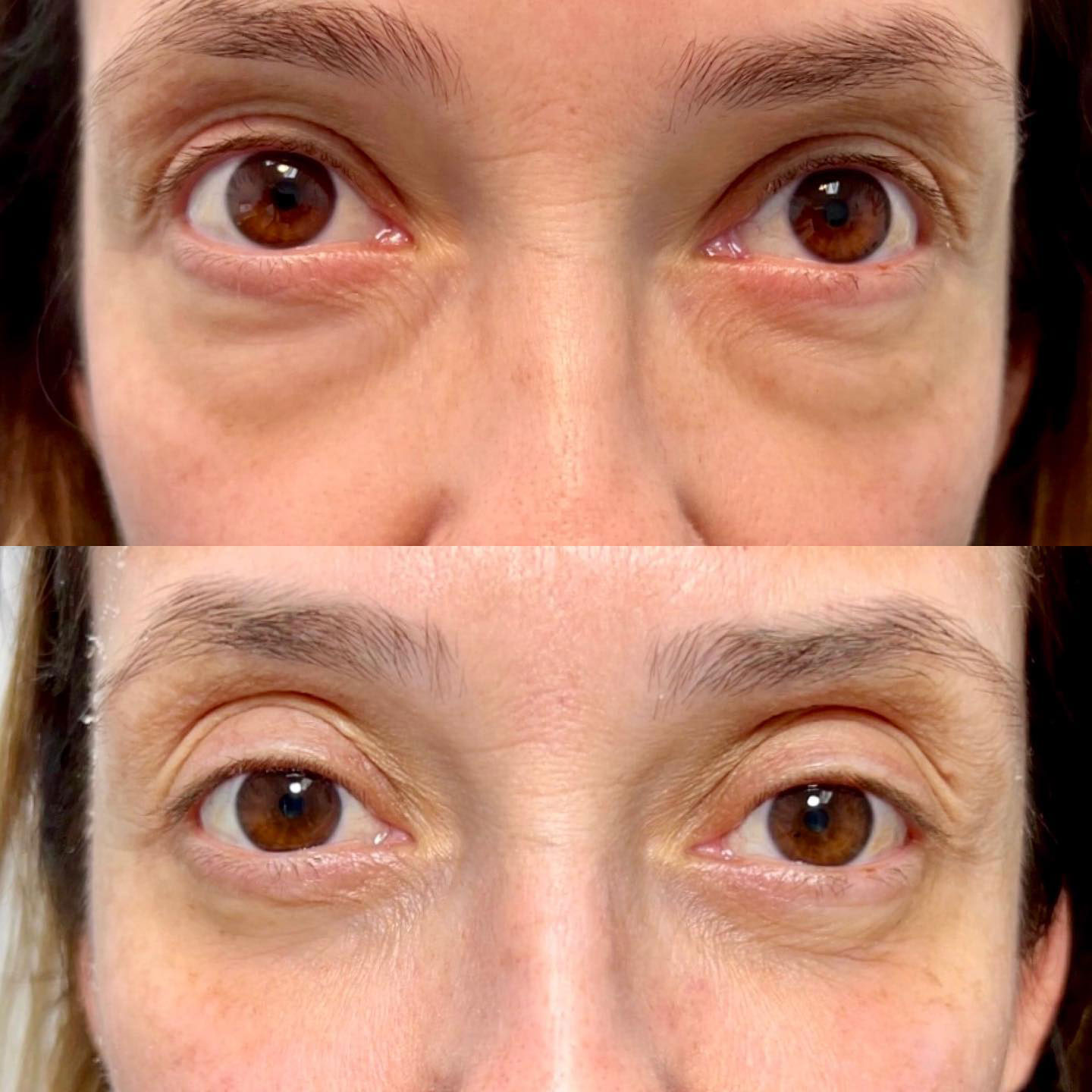 Blepharoplasty (Eyelid Surgery) Before & After - Female Patient by Dr. Soroudi - Los Angeles, Beverly Hills, Newport Beach & Glendale