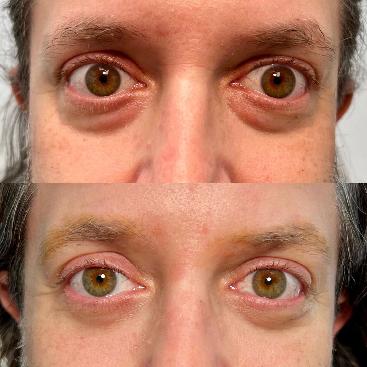 Blepharoplasty (Eyelid Surgery) Before & After - Male Patient by Dr. Soroudi - Los Angeles, Beverly Hills, Newport Beach & Glendale
