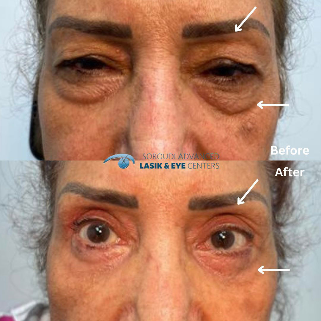Eyelid Rejuvenation by Dr. Soroudi - Los Angeles, Beverly Hills, Newport Beach & Glendale